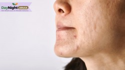 Understanding the Difference Between Age Spots and Sun Spots
